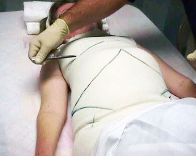 Providence® Orthosis plaster casting - Step 1