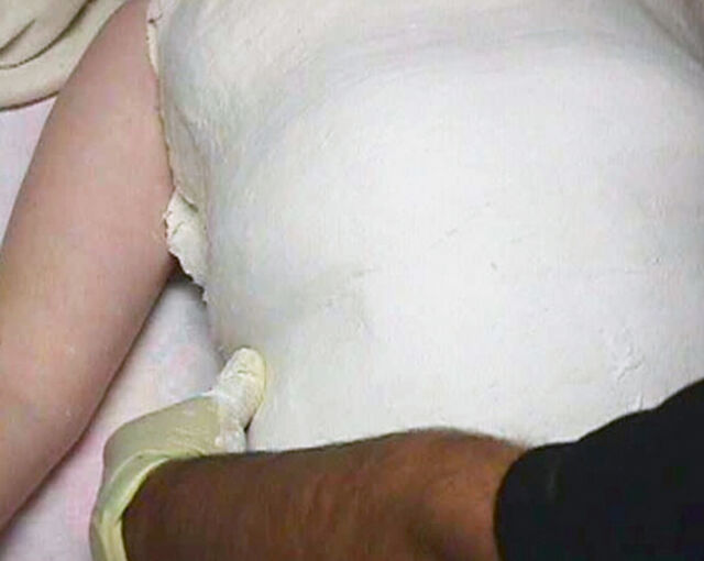 Providence® Orthosis plaster casting - Step 4