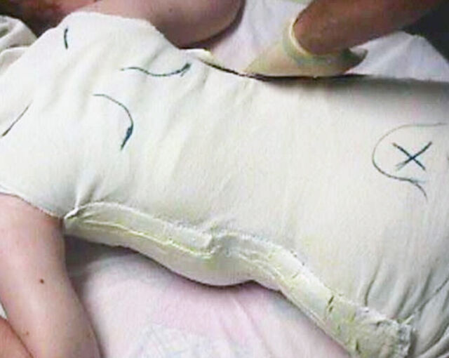 Providence® Orthosis plaster casting - Step 5