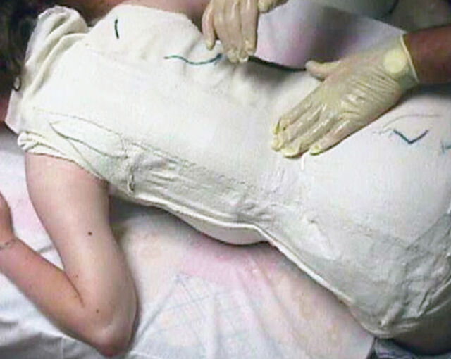 Providence® Orthosis plaster casting - Step 6