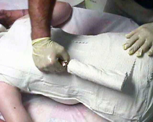 Providence® Orthosis plaster casting - Step 7