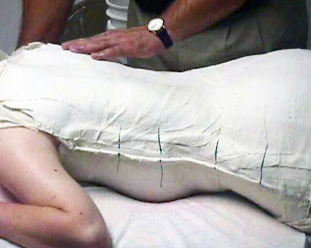 Providence® Orthosis plaster casting - Step 8