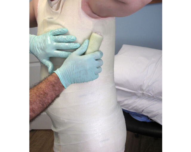 Providence® Orthosis synthetic material casting - Step 2