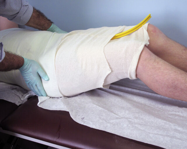 Providence® Orthosis synthetic material casting - Step 3