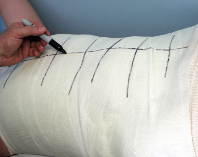 Providence® Orthosis synthetic material casting - Step 4