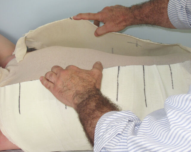 Providence® Orthosis synthetic material casting - Step 5
