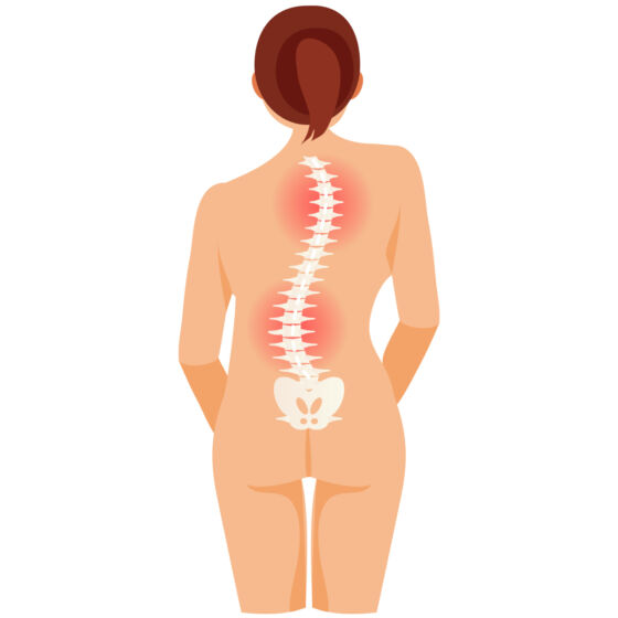 Double Curve Scoliosis