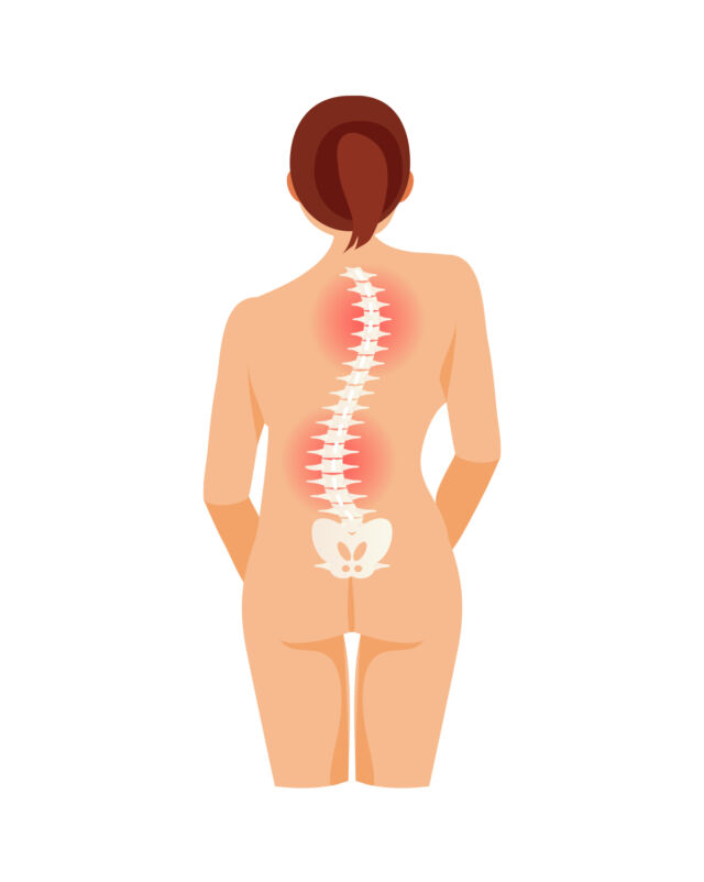 Double Curve Scoliosis