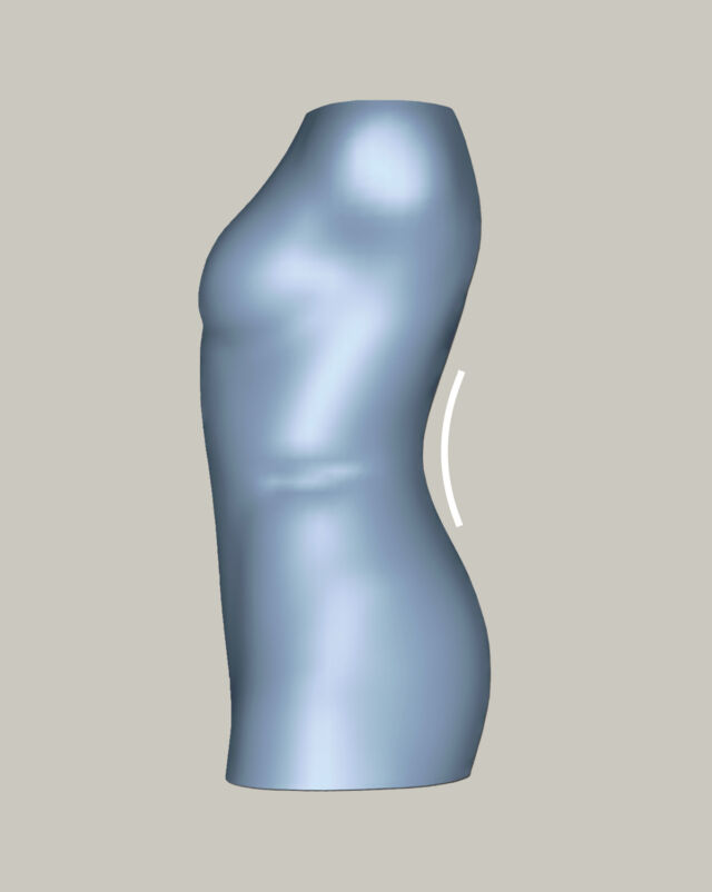 Lordosis