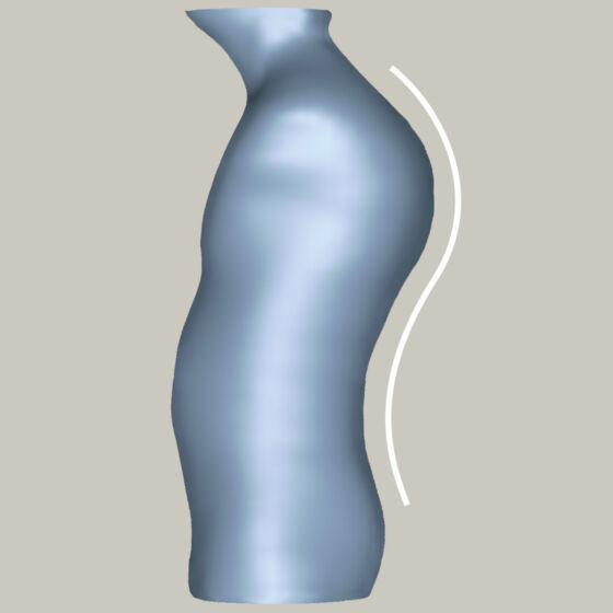 Kyphosis - 1