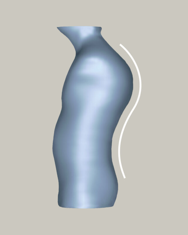 Kyphosis - 1