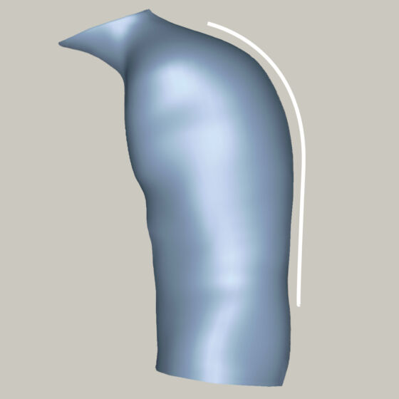 Kyphosis - 2