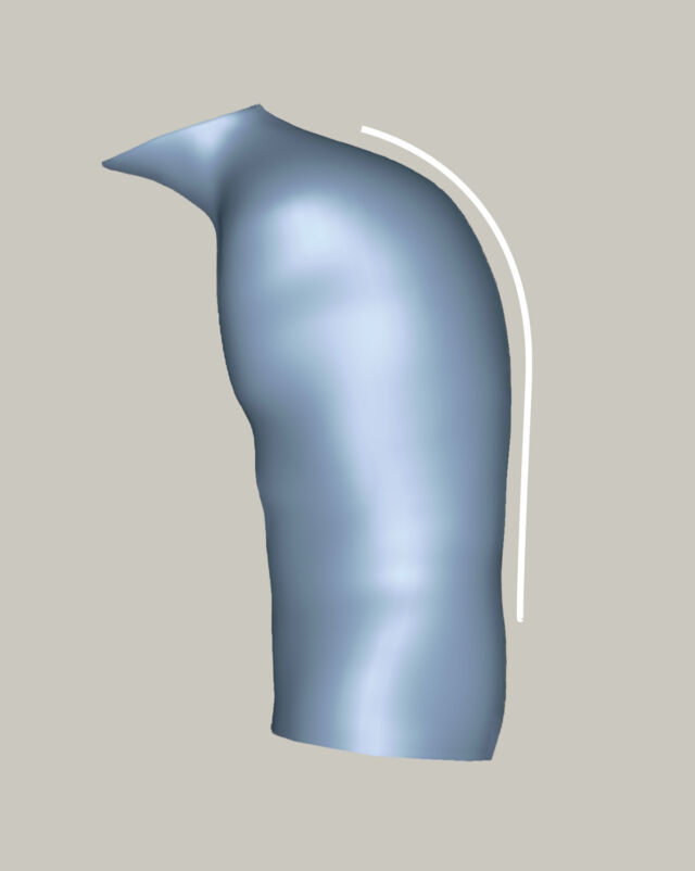 Kyphosis - 2