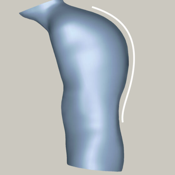 Kyphosis - 3