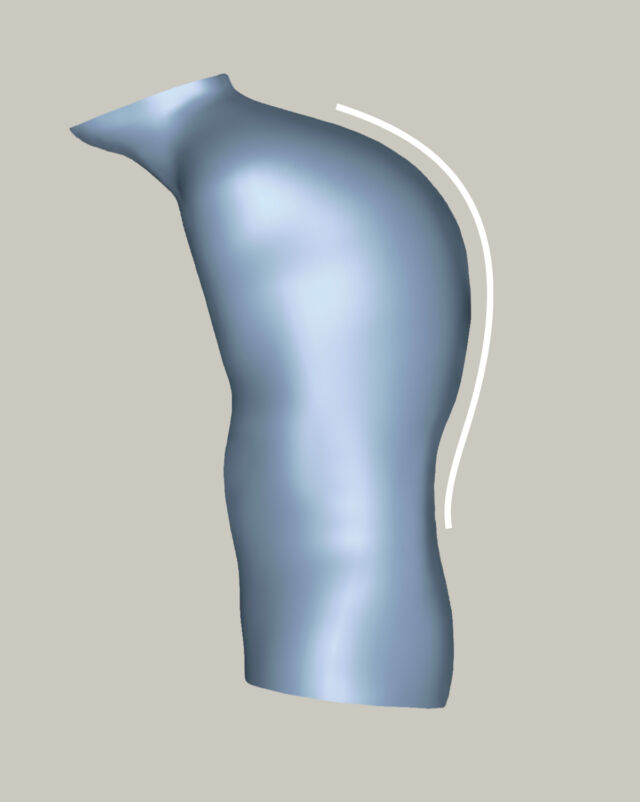 Kyphosis - 3