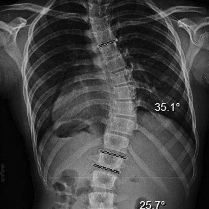 Scoliosis X-Ray with Rib Rotation