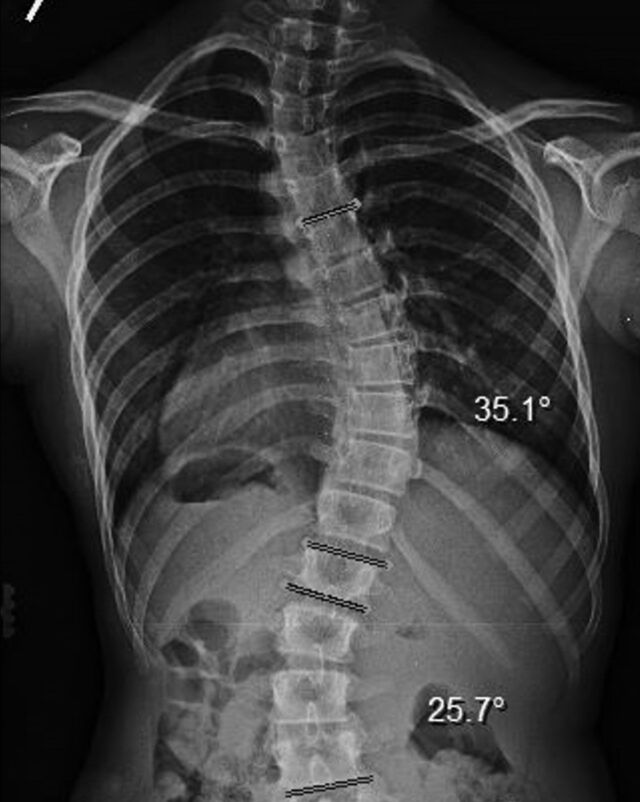 Scoliosis X-Ray with Rib Rotation