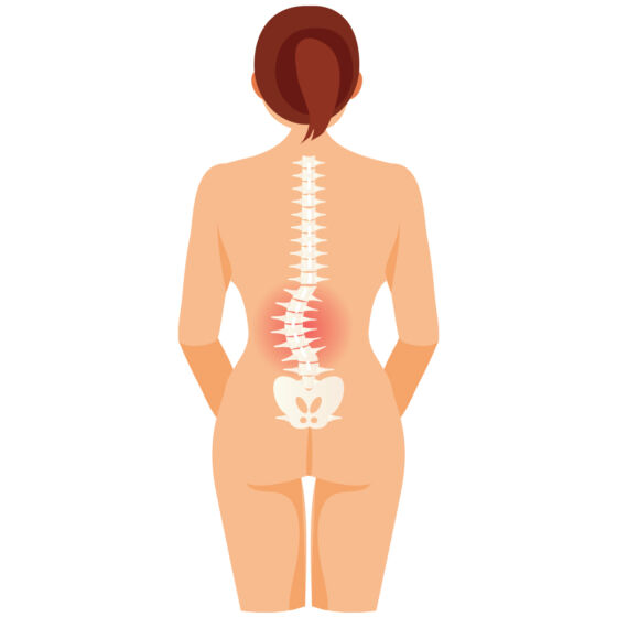 Lumbar Scoliosis