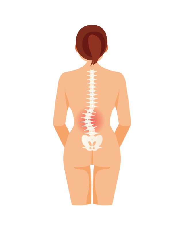 Lumbar Scoliosis