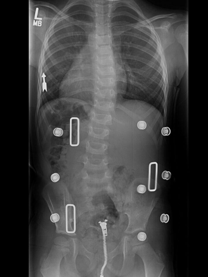 Cheneau X-Ray Set 1 In-Brace