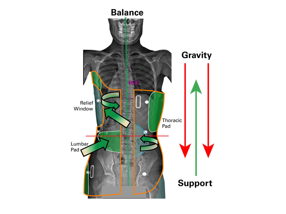 Lumbar Spine/Thoracic Spine, Load Relieving Brace