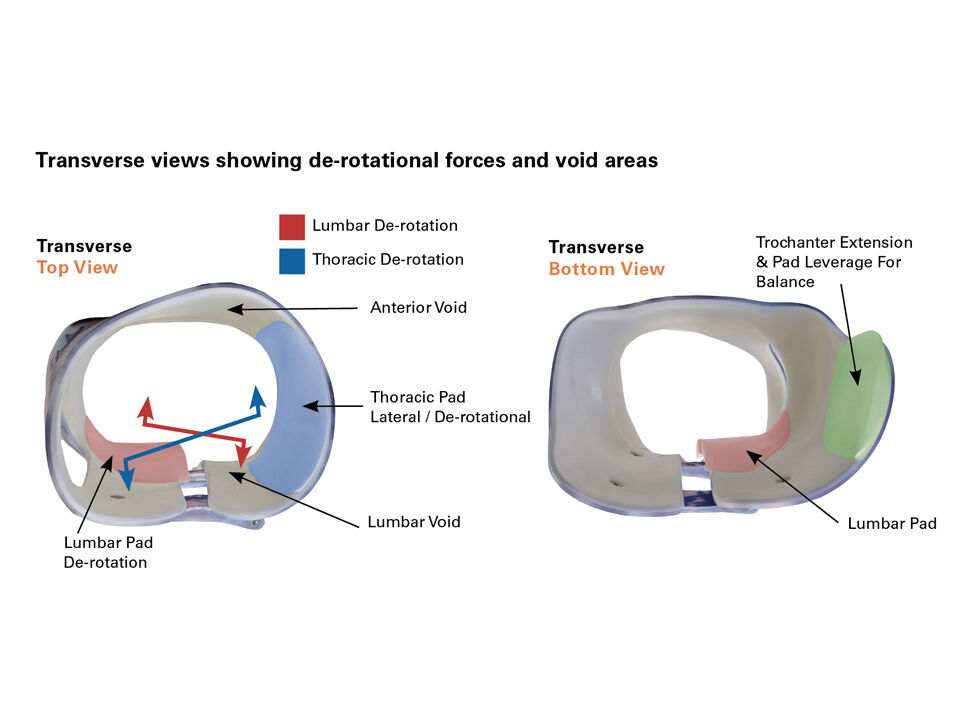 Transverse Views Braces