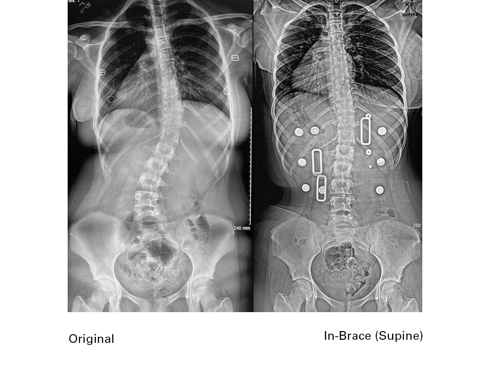 Boston spinal orthosis - Correction of scoliosis, Polyethylene (a  thermoformable plastic) spinal orthosis