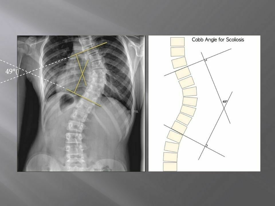 Scoliosis Rib Hump Results - Scoliosis Care Centers