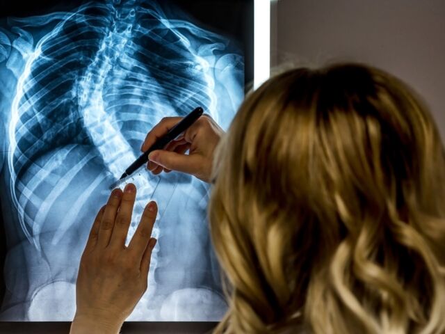 Scoliosis xray