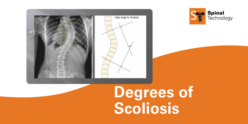 Degrees of scoliosis cover