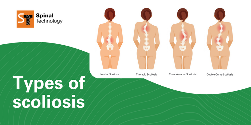 ST Types of scoliosis Blog Header 2