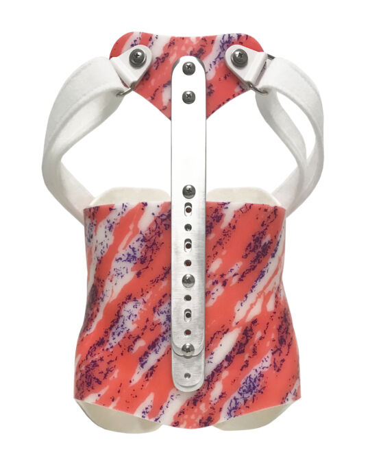 Kyphosis Front - Anterior View