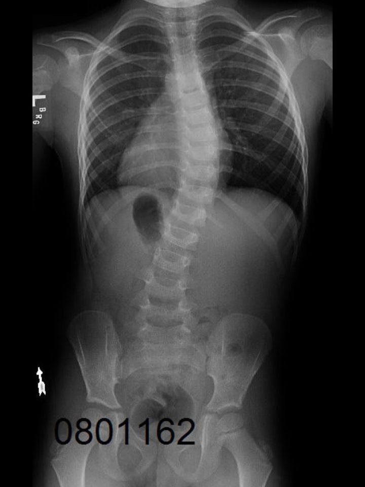 Cheneau X-Ray Set 1 Out of Brace