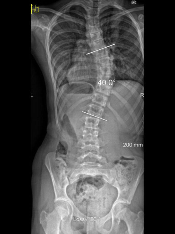 Wilmington X-Ray Set 3 Out of Brace