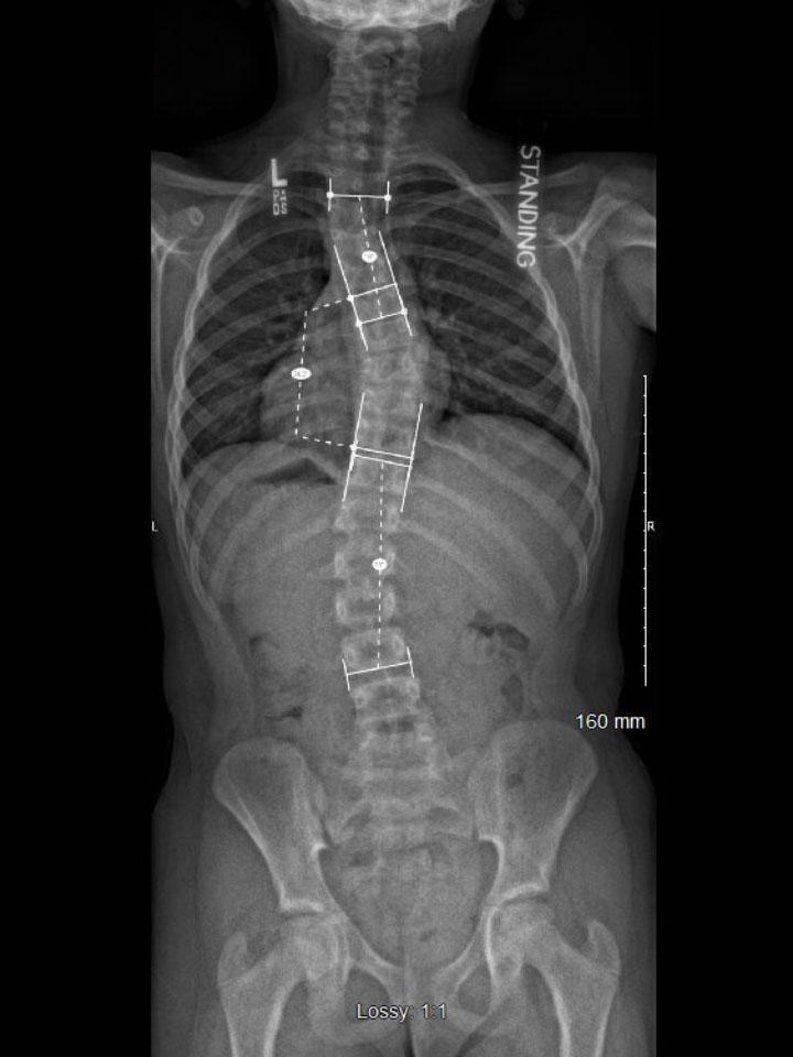 Wilmington X-Ray Set 6 Out of Brace