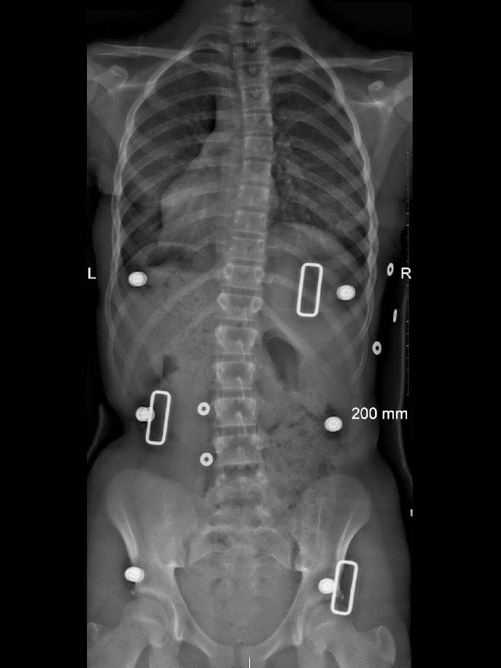 Full-Time X-Ray Set 1 In-Brace