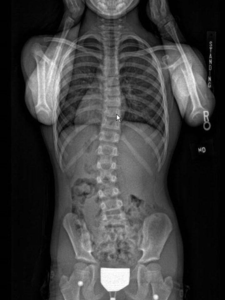 Full-Time X-Ray Set 2 Out of Brace