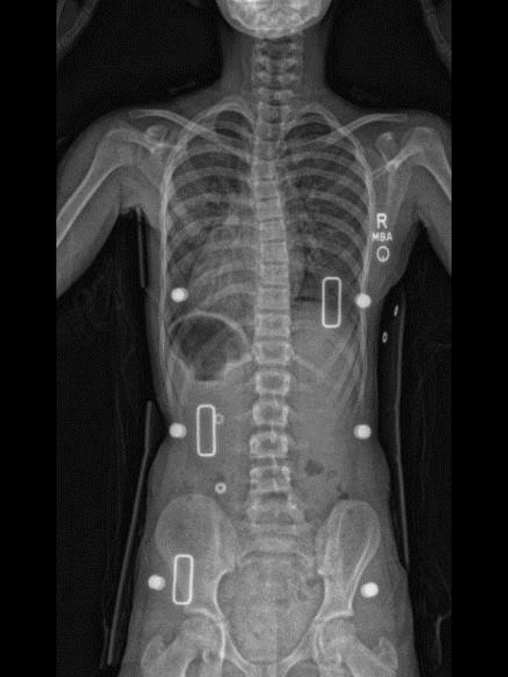 Full-Time X-Ray Set 3 In-Brace