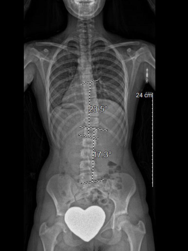 Full-Time X-Ray Set 6 Out of Brace