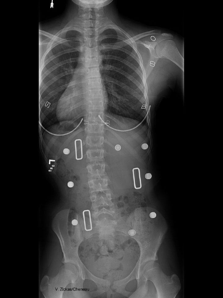 My Care Prosthetics and Orthotics on X: Boston brace for scoliosis is a  plastic body jacket used in the treatment of adolescents with idiopathic  scoliosis. The Boston brace, also referred to as