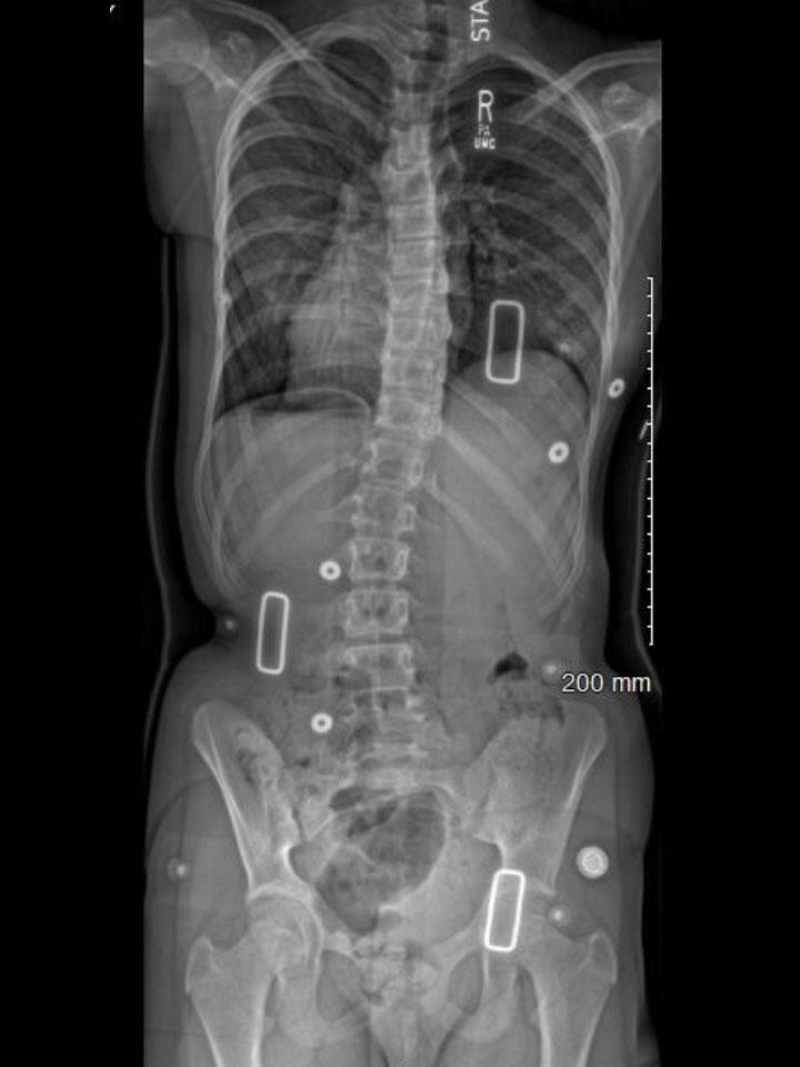 Wilmington X-Ray Set 1 In-Brace