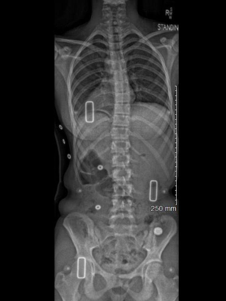 Wilmington X-Ray Set 2 In-Brace