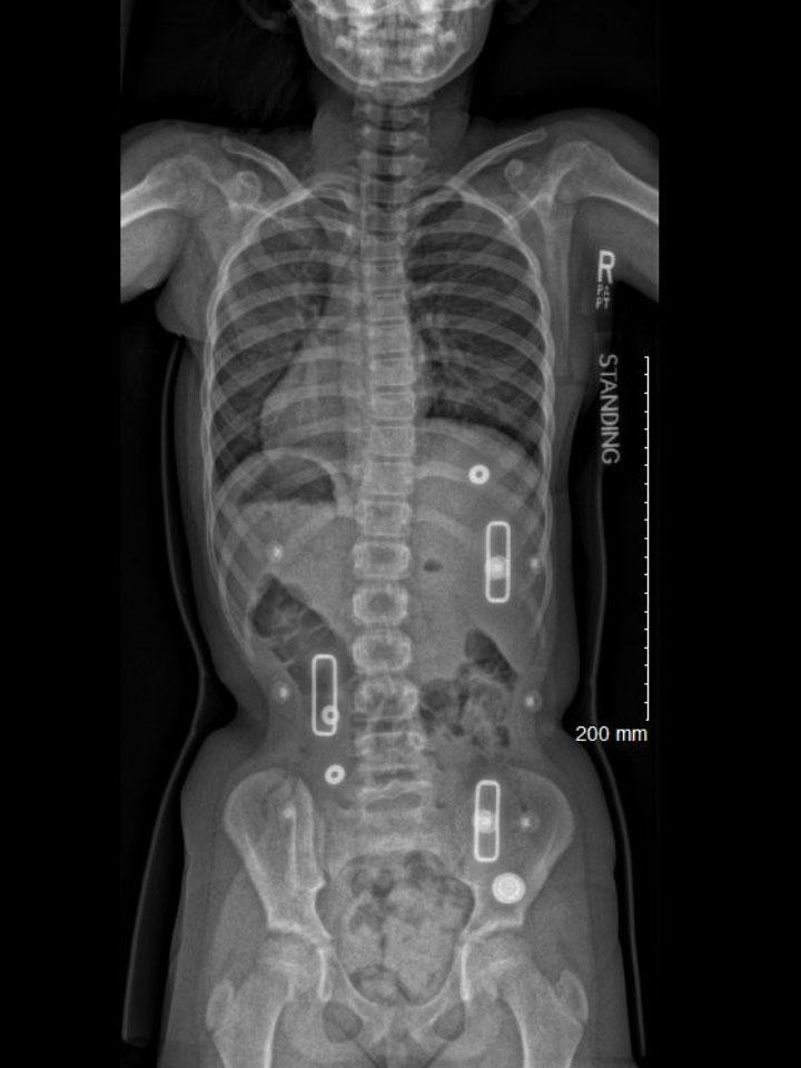 Wilmington X-Ray Set 5 In-Brace