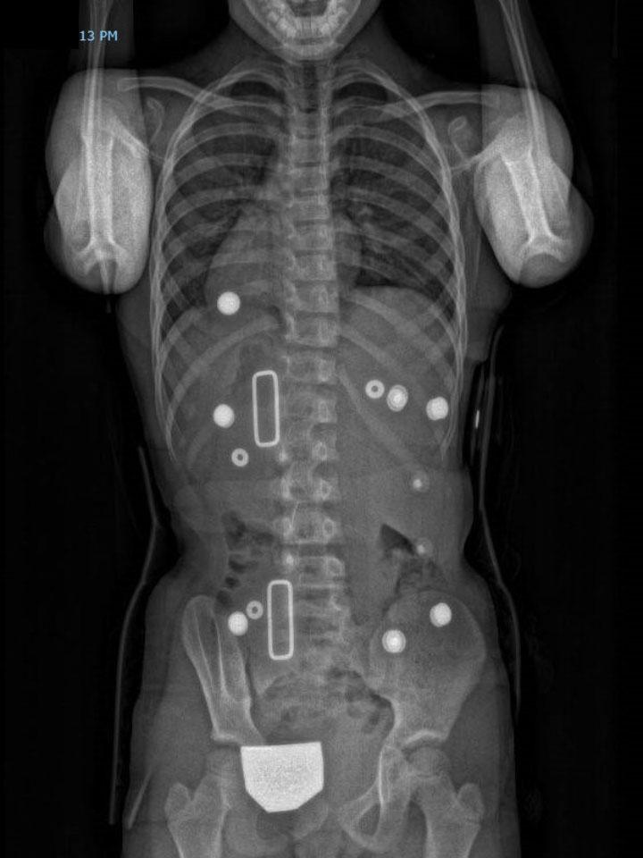 Full-Time X-Ray Set 2 In-Brace