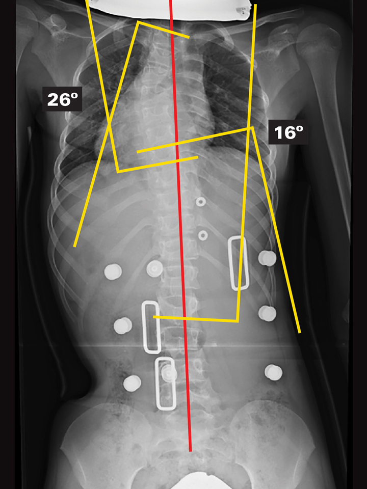 In-Brace X-Ray (Supine)
