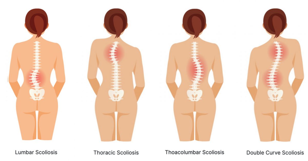 spinal-tech-types-of-scoliosis