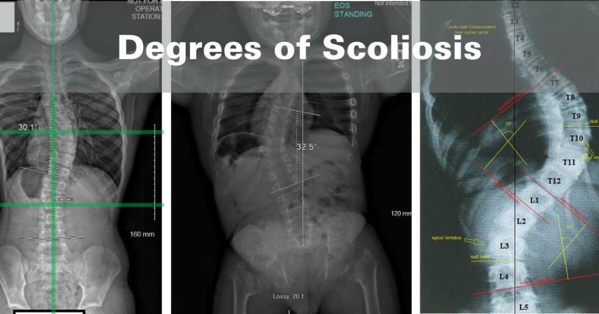 spinal-technology-what-are-the-different-scoliosis-curves-called