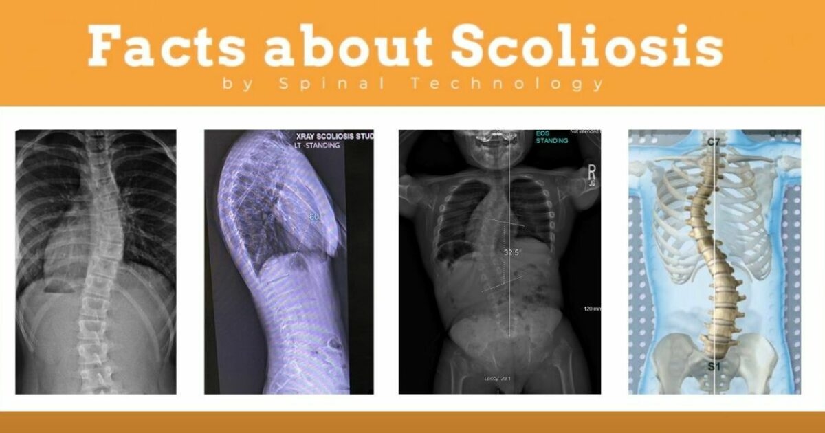 Spinal Tech | Facts About Scoliosis