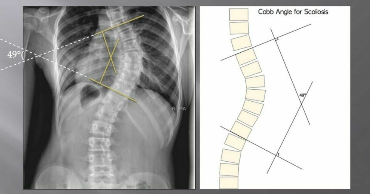 Spinal Technology Early Detection of Scoliosis